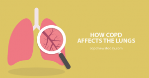 People with Stable COPD Seen to Do Better on LAMA Than LABA Therapies ...